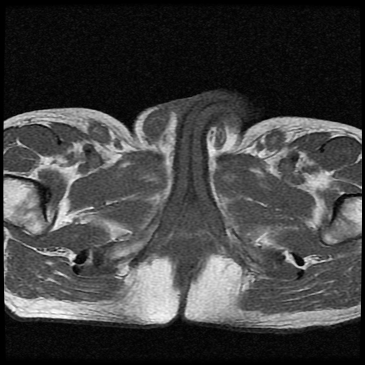 File:Necrotizing epididymo-orchitis with intra-testicular abscess (Radiopaedia 29397-29860 Axial T1 9).jpg
