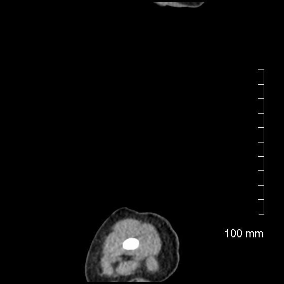 File:Neonatal neuroblastoma (Radiopaedia 56651-63438 C 7).jpg