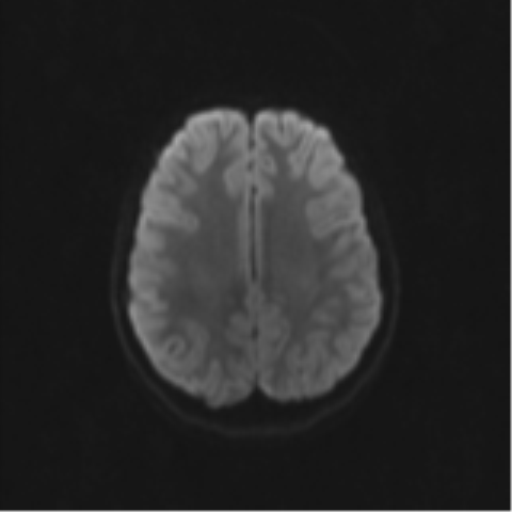 Neurenteric cyst (Radiopaedia 58641-65837 Axial DWI 59).png
