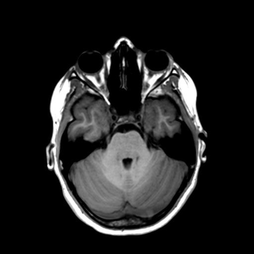 Neurenteric cyst (Radiopaedia 58641-65837 Axial T1 18).png