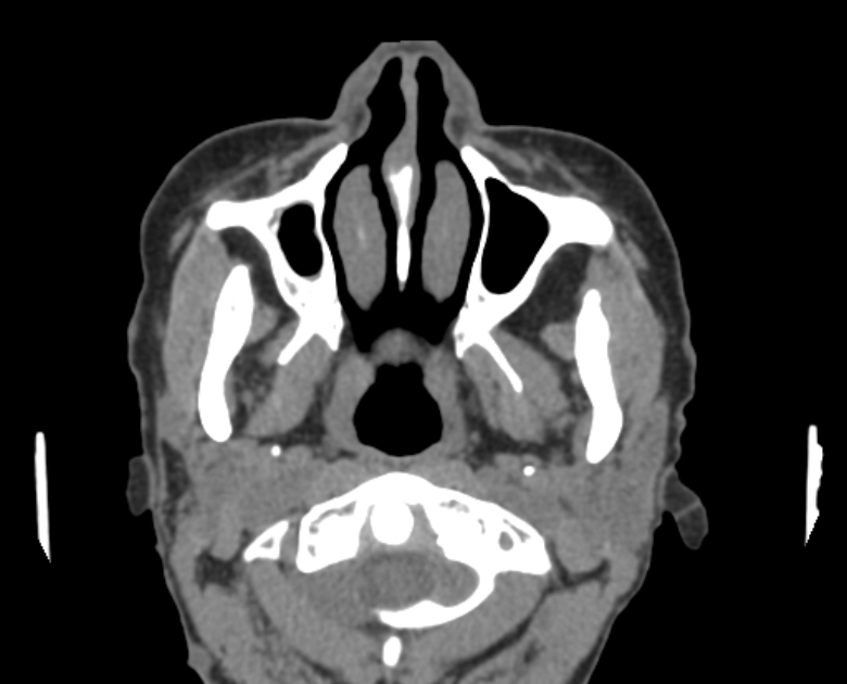 Neurofibromatosis type 1- orbital manifestations (Radiopaedia 49391-54511 Axial non-contrast 17).jpg