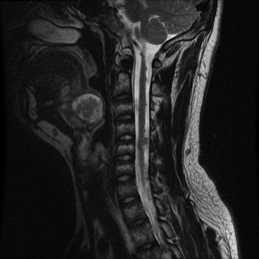 File:Neurofibromatosis type 2 (Radiopaedia 44936-48837 Sagittal T2 10).png