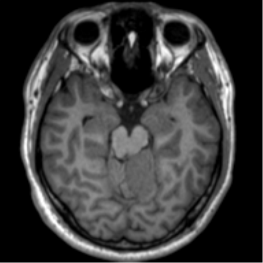 File:Neurofibromatosis type 2 (Radiopaedia 44936-48838 Axial T1 50).png