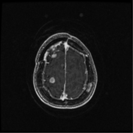 Neurofibromatosis type 2 (Radiopaedia 45229-49244 Axial T1 C+ 99).png