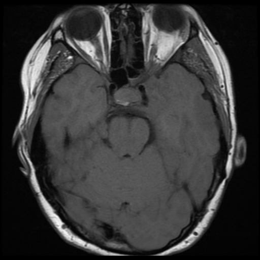 File:Neurofibromatosis type 2 (Radiopaedia 45229-49251 Axial T1 13).png