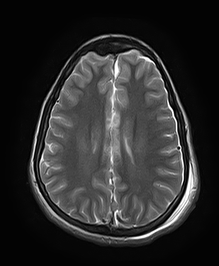 File:Neurofibromatosis type 2 (Radiopaedia 66211-75401 Axial T2 20).jpg