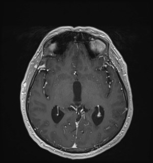Neurofibromatosis type 2 (Radiopaedia 79097-92049 Axial T1 C+ 99).jpg