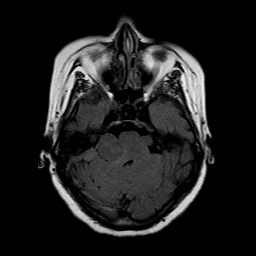 File:Neurofibromatosis type 2 (Radiopaedia 8713-9518 Axial FLAIR 18).jpg