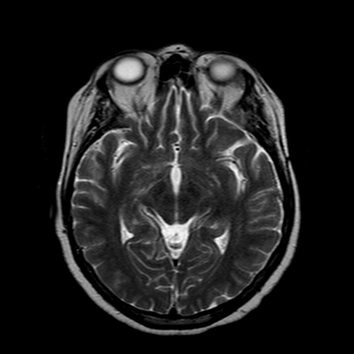 File:Neurofibromatosis type 2 (Radiopaedia 8713-9518 Axial T2 14).jpg