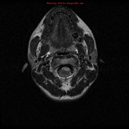 File:Neurofibromatosis type 2 (Radiopaedia 8953-9730 Axial FLAIR 2).jpg