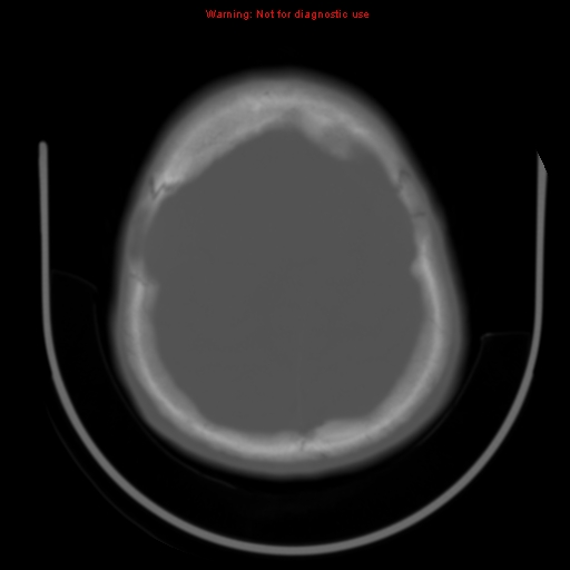 File:Neurofibromatosis type 2 (Radiopaedia 8953-9732 Axial bone window 27).jpg