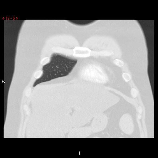 File:Non-specific interstitial pneumonitis (Radiopaedia 27044-27222 Coronal lung window 5).jpg