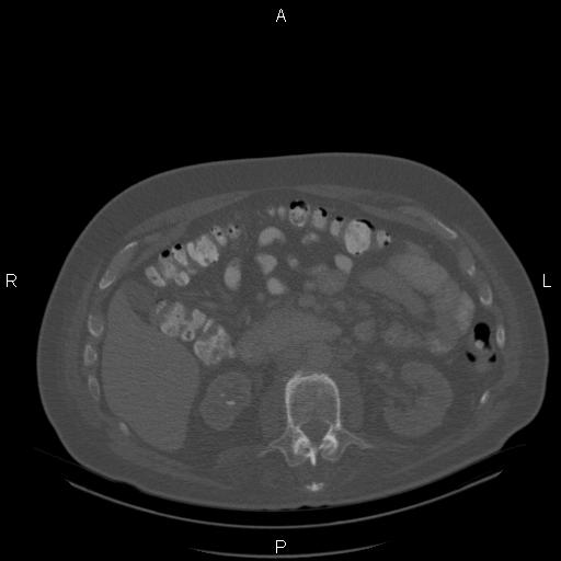 Non Hodgkin lymphoma in a patient with ankylosing spondylitis (Radiopaedia 84323-99624 Axial bone window 38).jpg