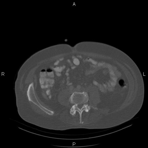 Non Hodgkin lymphoma in a patient with ankylosing spondylitis (Radiopaedia 84323-99624 Axial bone window 47).jpg