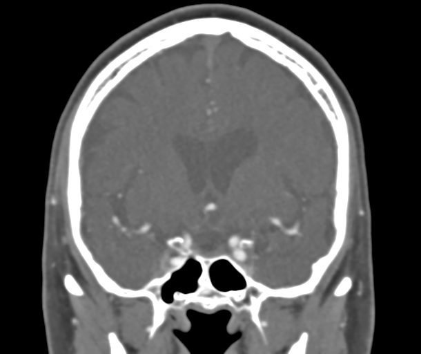 File:Normal CTA head (Radiopaedia 40801-43464 B 42).png