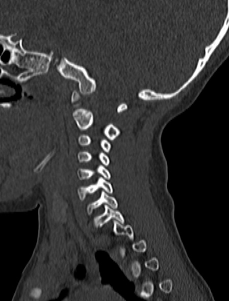 Normal CT cervical spine - pediatric (Radiopaedia 52549-58462 Sagittal bone window 149).jpg