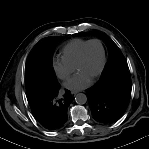 File:Normal CT intravenous cholangiogram (Radiopaedia 38199-40208 Axial IVC 4).png