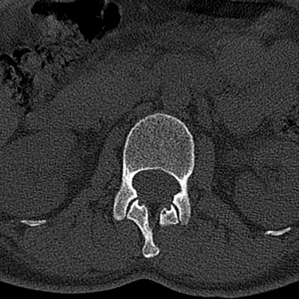 File:Normal CT lumbar spine (Radiopaedia 53981-60118 Axial bone window 20).jpg