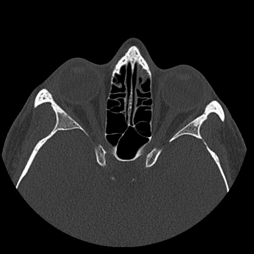 Normal CT paranasal sinuses (Radiopaedia 42286-45390 Axial bone window 44).jpg