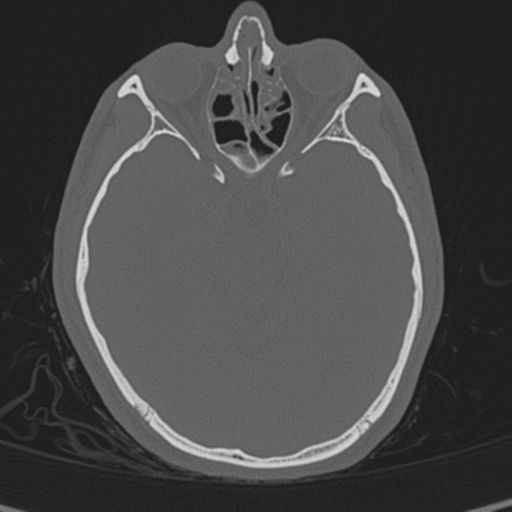 Normal CT skull (Radiopaedia 40798-43459 A 62).png