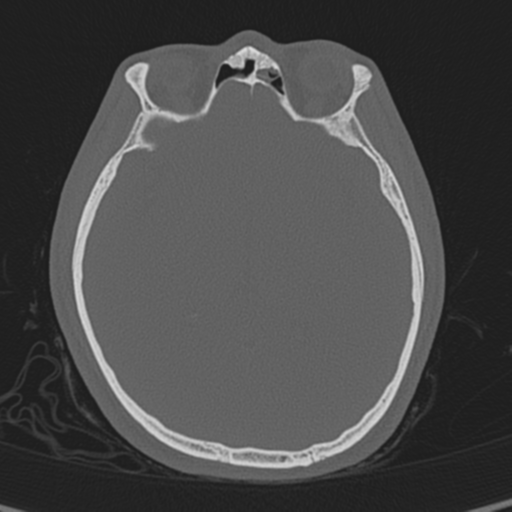 Normal CT skull (Radiopaedia 40798-43459 A 77).png
