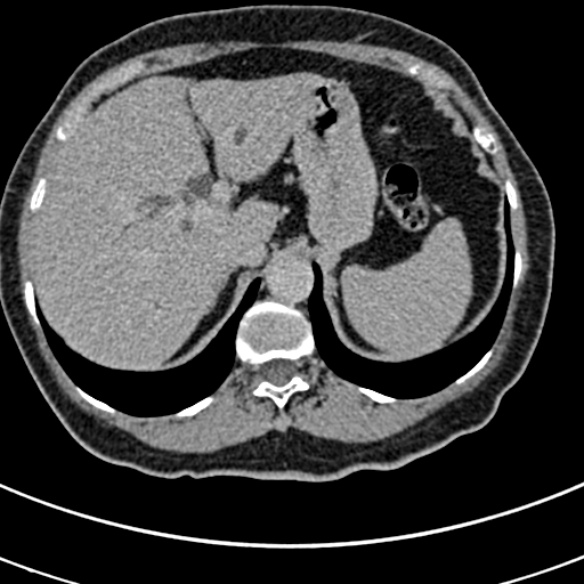File:Normal CT split bolus study of the renal tract (Radiopaedia 48631-53634 Axial split bolus 1).jpg