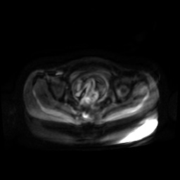 Normal MRI abdomen in pregnancy (Radiopaedia 88001-104541 Axial DWI 45).jpg