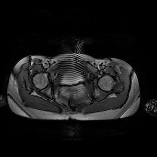 File:Normal MRI abdomen in pregnancy (Radiopaedia 88001-104541 Axial Gradient Echo 54).jpg