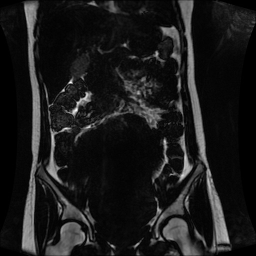 Normal MRI abdomen in pregnancy (Radiopaedia 88001-104541 N 65).jpg