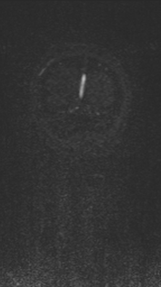 Normal MRI brain with MRV- teenager (Radiopaedia 49425-54553 Coronal MRV 218).jpg