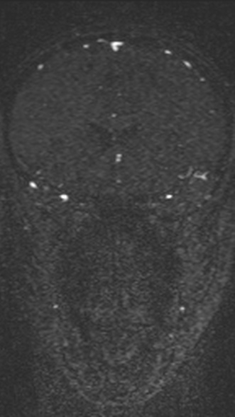 Normal MRI brain with MRV- teenager (Radiopaedia 49425-54553 Coronal MRV 93).jpg