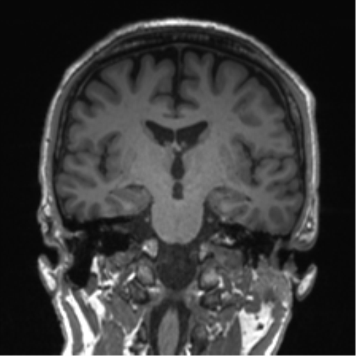 Normal brain MRI (non-focal epilepsy protocol) (Radiopaedia 53917-60040 Coronal T1 35).png
