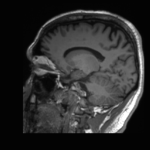Normal brain MRI (non-focal epilepsy protocol) (Radiopaedia 53917-60040 Sagittal T1 42).png