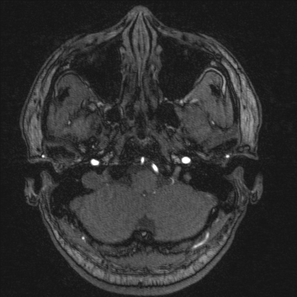 Normal brain MRI including MRA (Radiopaedia 48748-53763 Axial MRA 24).jpg