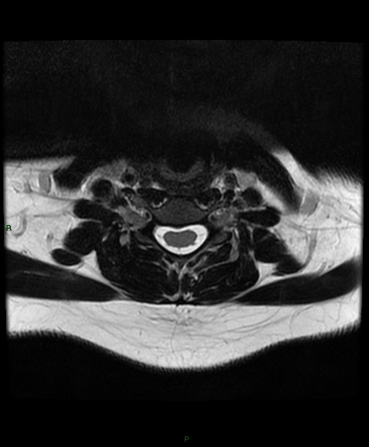Normal cervical spine MRI (Radiopaedia 80146-93454 Axial T2 63).jpg