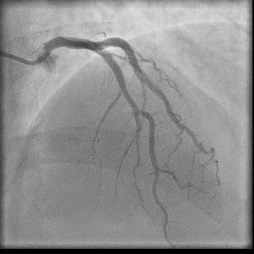 Normal coronary angiogram (DSA) (Radiopaedia 63081-71571 E 47).jpg
