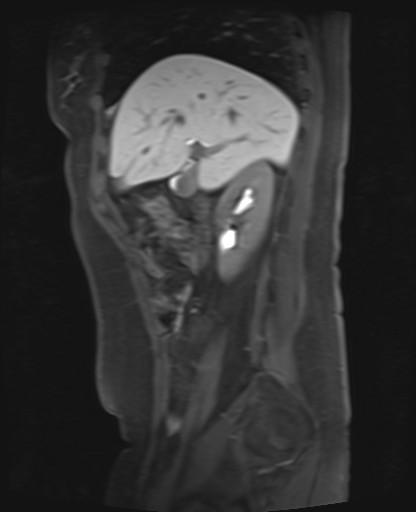 File:Normal hepatobiliary phase liver MRI (Radiopaedia 58968-66230 C 25).jpg