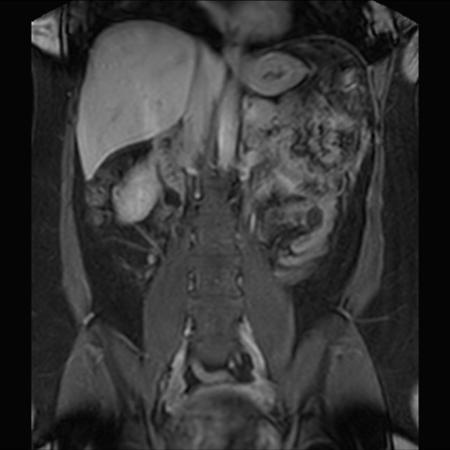Normal liver MRI with Gadolinium (Radiopaedia 58913-66163 P 49).jpg