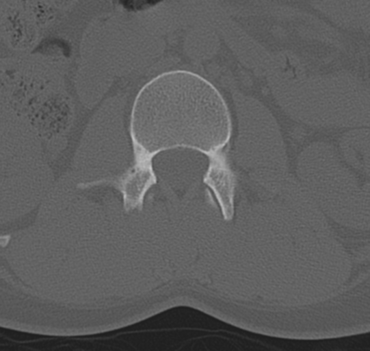 File:Normal lumbar spine CT (Radiopaedia 46533-50986 Axial bone window 21).png