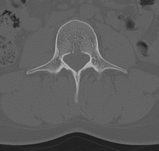 File:Normal lumbar spine CT (Radiopaedia 46533-50986 Axial bone window 35).png