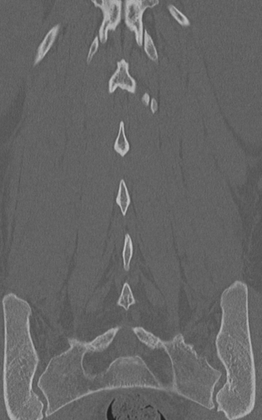 Normal lumbar spine CT (Radiopaedia 46533-50986 Coronal bone window 57).png