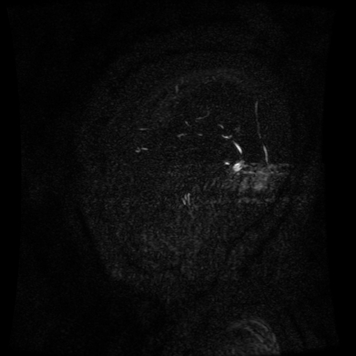 Normal noncontrast MR venography (Radiopaedia 87578-103957 A 10).jpg