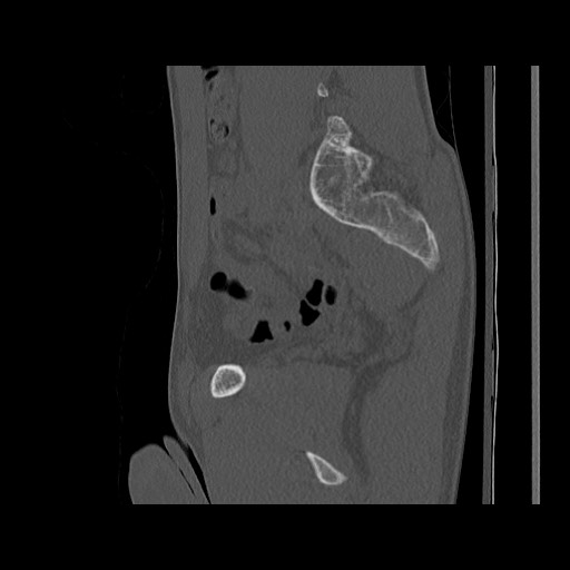 Normal pelvis (Radiopaedia 51473-57238 Sagittal bone window 57).jpg