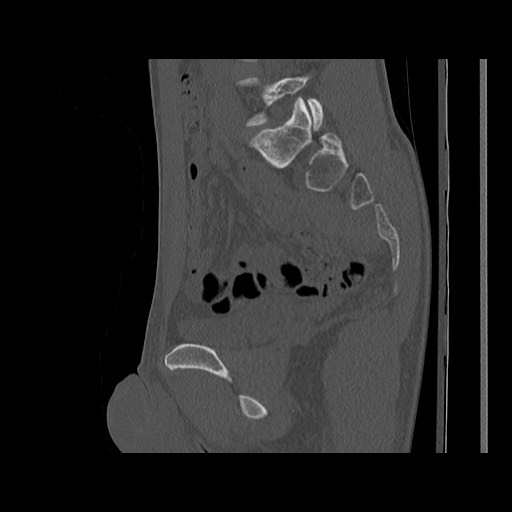 Normal pelvis (Radiopaedia 51473-57238 Sagittal bone window 64).jpg