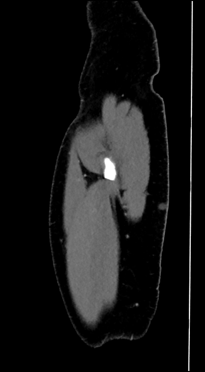Normal pelvis CT angiogram (Radiopaedia 84966-100481 C 2).jpg