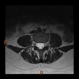 File:Normal spine MRI (Radiopaedia 77323-89408 Axial T2 13).jpg