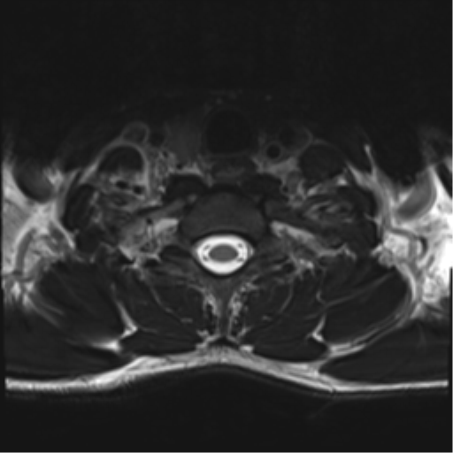 Normal trauma cervical spine (Radiopaedia 41017-43762 D 51).png
