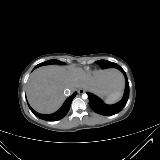 File:Nutmeg liver- Budd-Chiari syndrome (Radiopaedia 46234-50635 A 10).png