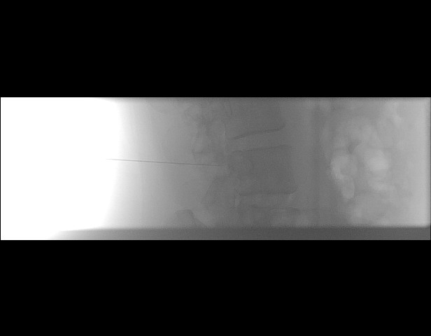 File:Oblique sublaminar lumbar puncture (Radiopaedia 90103-107280 A 2).jpeg