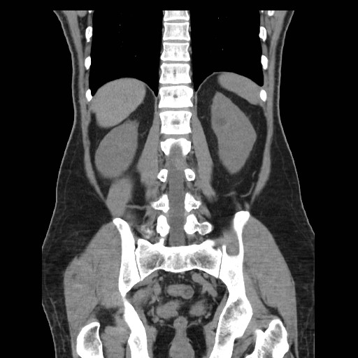 File:Obstructed kidney with perinephric urinoma (Radiopaedia 26889-27067 Coronal non-contrast 22).jpg